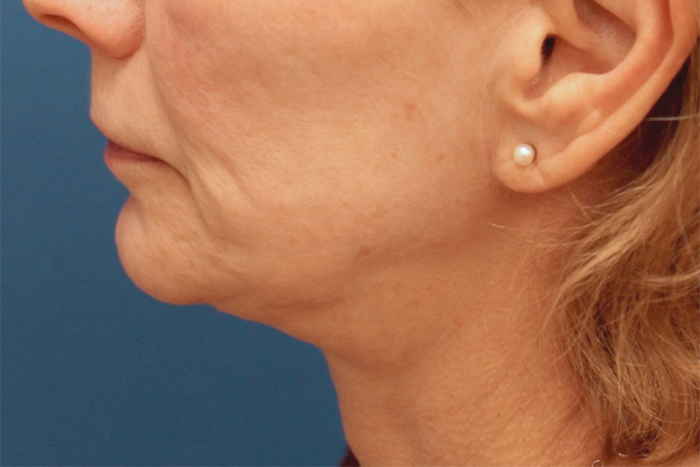 Face And Neck Lift Case 21 Cascade Facial Surgery And Aesthetics Mt Vernon