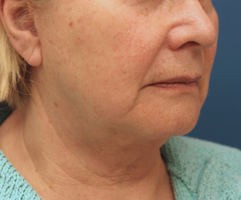 Face And Neck Lift Case 25 Cascade Facial Surgery And Aesthetics Mt Vernon