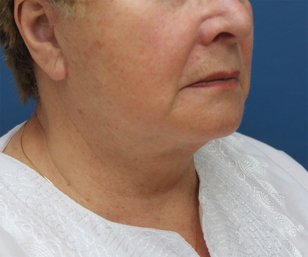 Face And Neck Lift Case 25 Cascade Facial Surgery And Aesthetics Mt Vernon