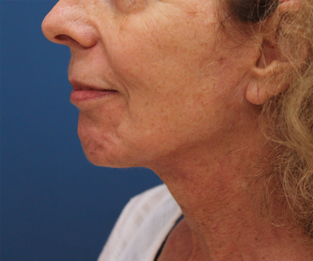 Face And Neck Lift Case 26 Cascade Facial Surgery And Aesthetics Mt Vernon