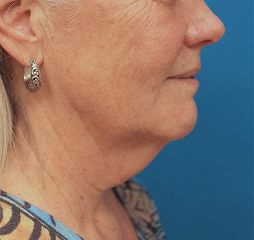 Face And Neck Lift Case 17 Cascade Facial Surgery And Aesthetics Mt Vernon