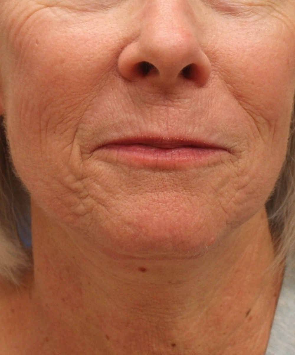 Fractionated C Laser Skin Resurfacing Archives Cascade Facial Surgery And Aesthetics Mt Vernon