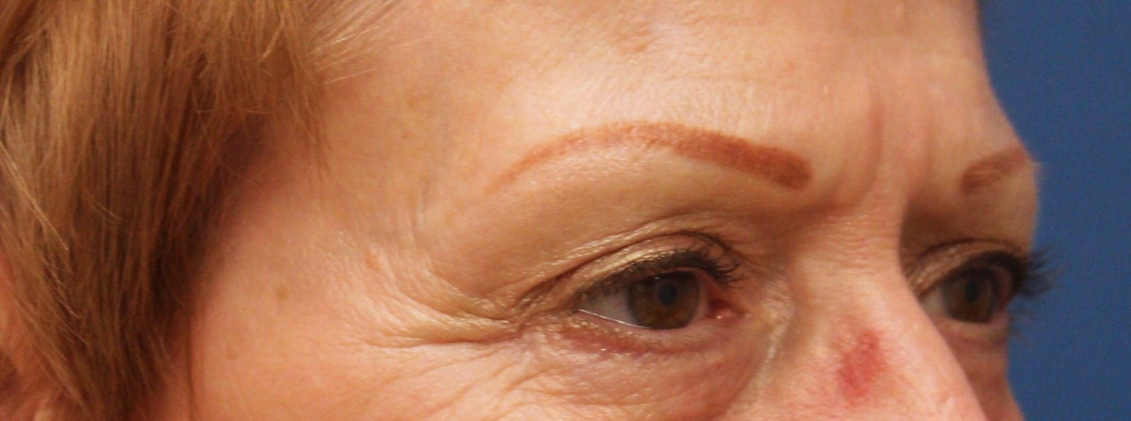 Eyelid Surgery Case 12 - Cascade Facial Surgery And Aesthetics Mt. Vernon