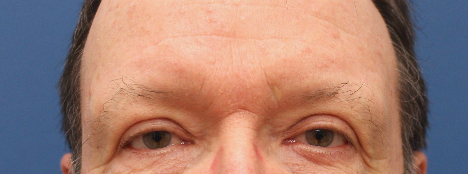 Eyelid Surgery Archives - Cascade Facial Surgery And Aesthetics Mt. Vernon