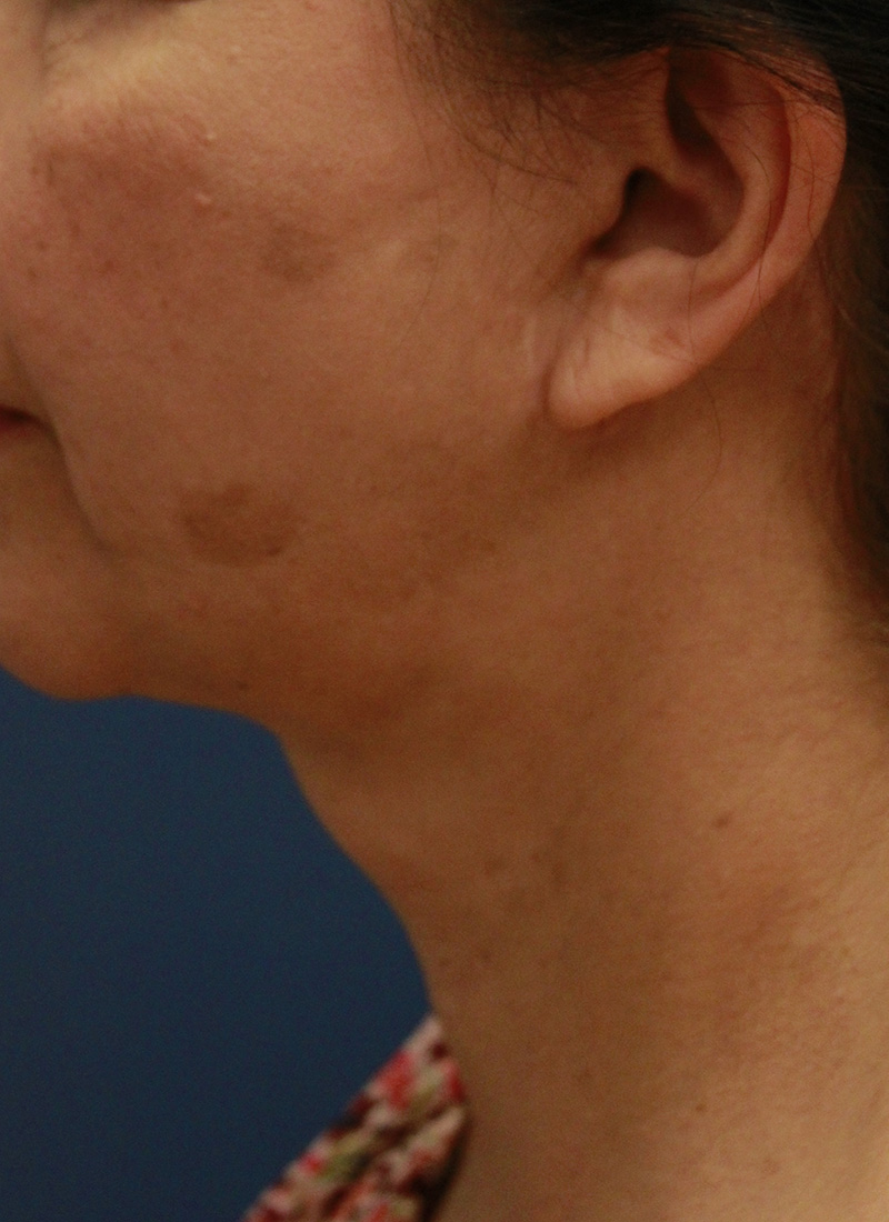 Face And Neck Lift Case 36 Cascade Facial Surgery And Aesthetics Mt Vernon