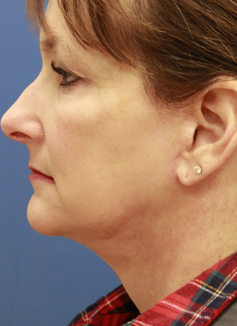 Face And Neck Lift Archives Cascade Facial Surgery And Aesthetics Mt Vernon