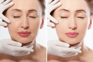 Dermal filler FAQs in Mt. Vernon, WA