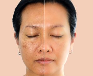 Laser treatment for sun damage in Mt. Vernon, WA